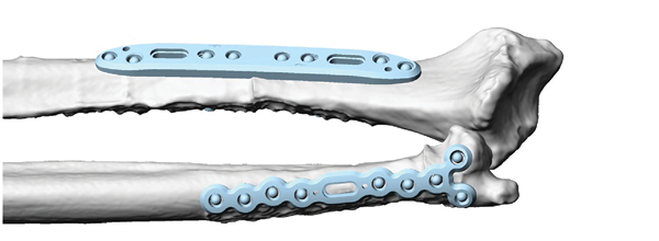 CMX Patient-Specific - Mandible Reconstruction