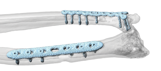 CMX Patient-Specific - Mandible Reconstruction
