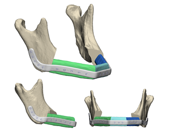CMX Patient-Specific - Mandible Reconstruction