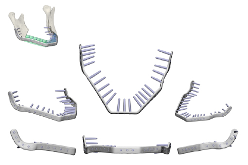 CMX Patient-Specific - Mandible Reconstruction
