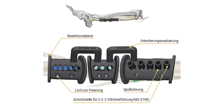 CMX Patient-Specific - Mandible Reconstruction